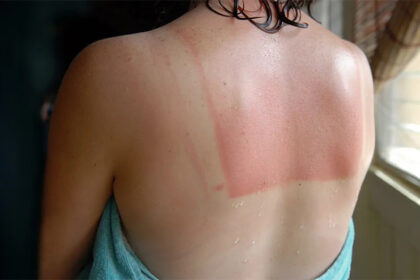 Tips on what to do when you get a sunburn.