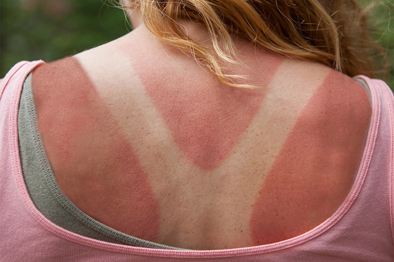 Tips on what to do when you get a sunburn.